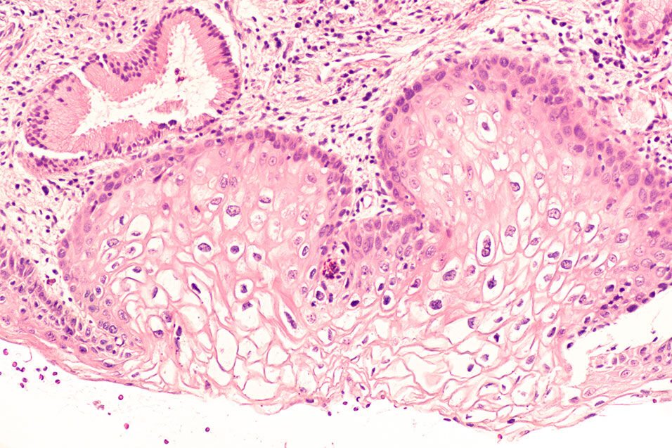 Biopsie des Gebärmutterhalses unter dem Mikroskop, mit leichten Zellveränderungen (CINI)